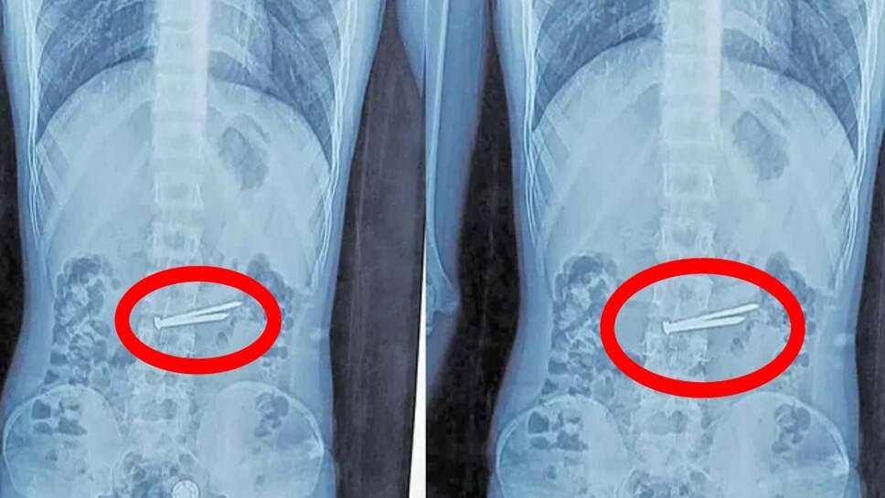 Viral news : जेल में सजा काट रहे कैदी के पेट में मिलीं रबर की बॉल, ब्लेड, कील, एक्स-रे देख डॉक्टर भी हैरान